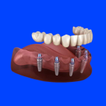 Full mouth Implant